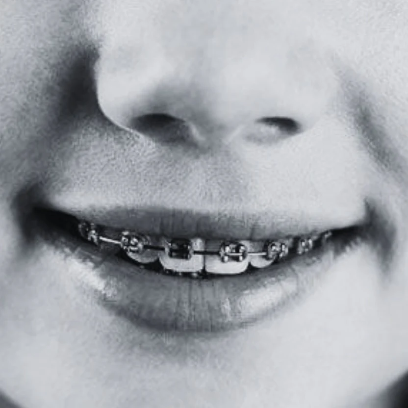 Brackets metálicos